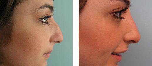 NONSURGICALnosejob_beforeafter1