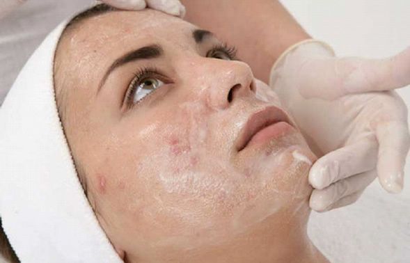 chemical peels, facial, treatment, bridal treatment, face, skin care