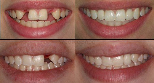 Photo By Smile Up Dental Care & Implant Center - Bridal Makeup