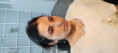 vitiligo bride